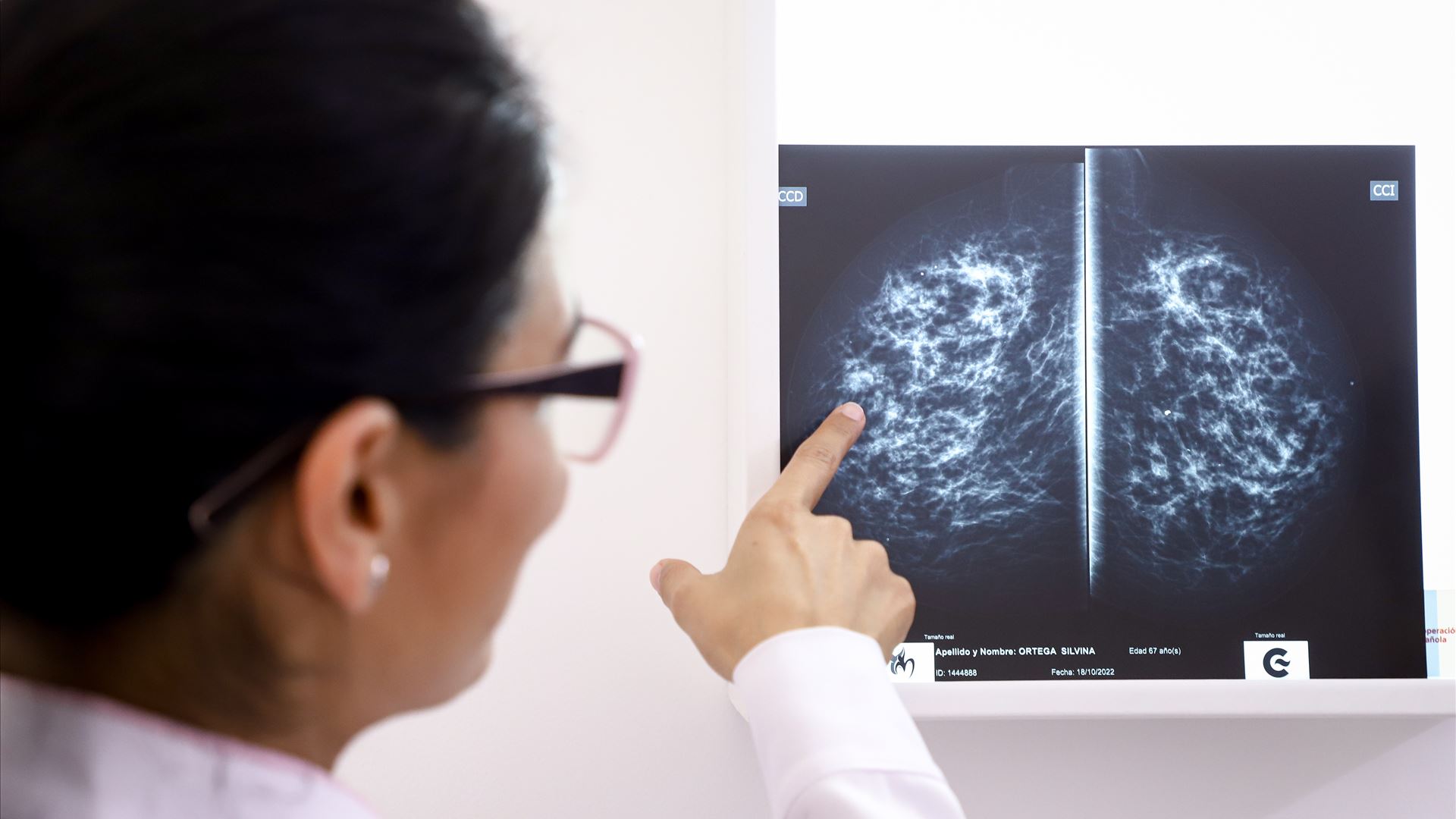 Baixa dose de tamoxifeno pode reduzir risco de cancro da mama voltar e efeitos adversos