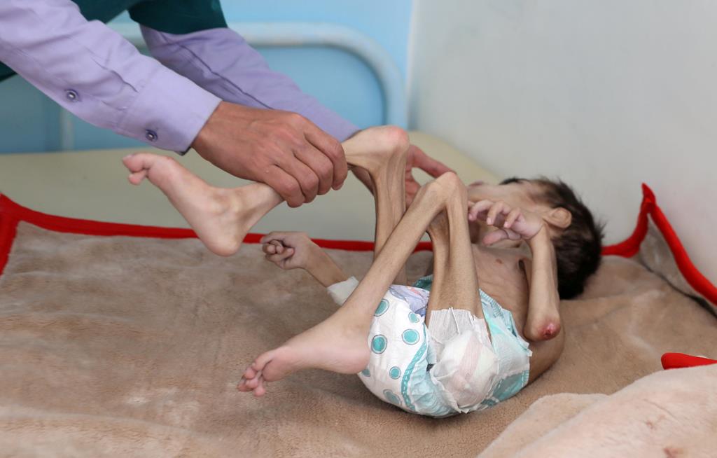 Faid Samim tem 7 anos e pesa 7 quilos. É uma das 1.8 milhões de crianças malnutridas do Iémen