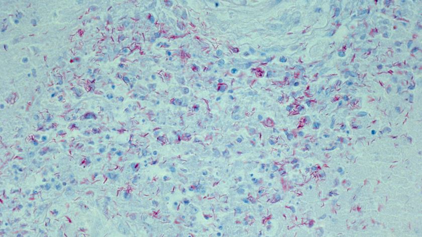 Caso de meningite em escola dos Açores "não é de alarme" Caso de meningite em escola dos Açores "não é de alarme"
