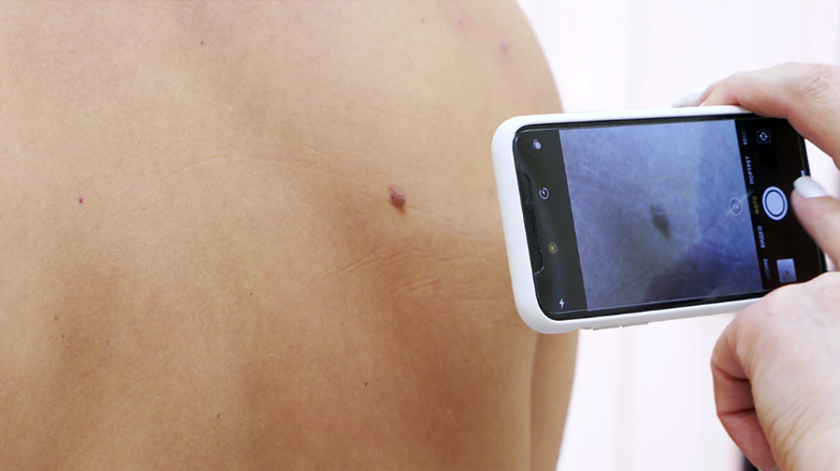 Fotografar um sinal e detetar cancro de pele? Plataforma "made in Portugal" agiliza diagnóstico Fotografar um sinal e detetar cancro de pele? Plataforma "made in Portugal" agiliza diagnóstico