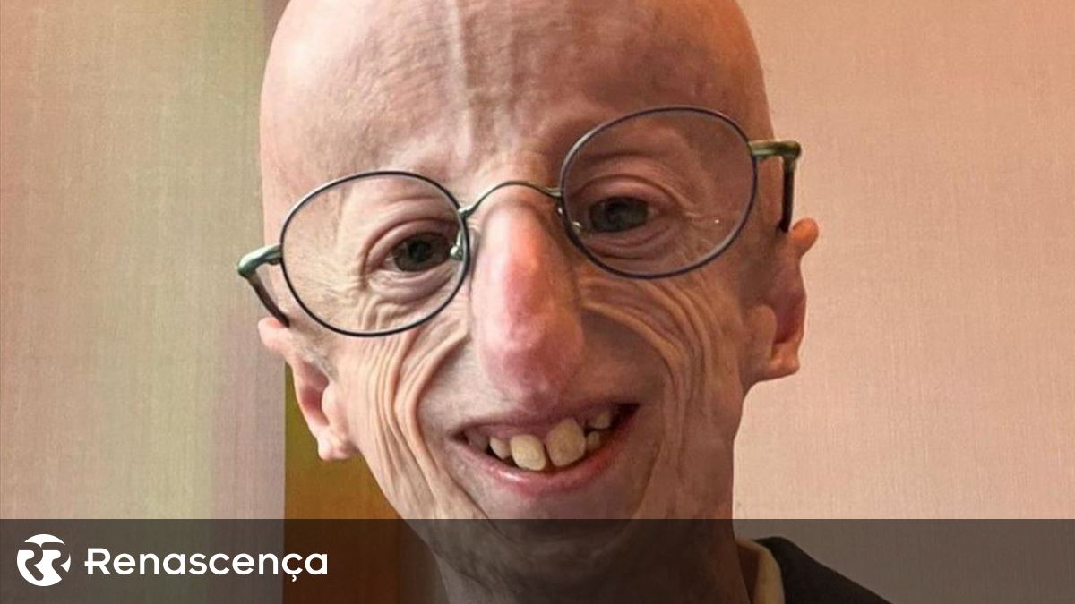 Jovem com doença rara que causa envelhecimento precoce morre aos 28 ...